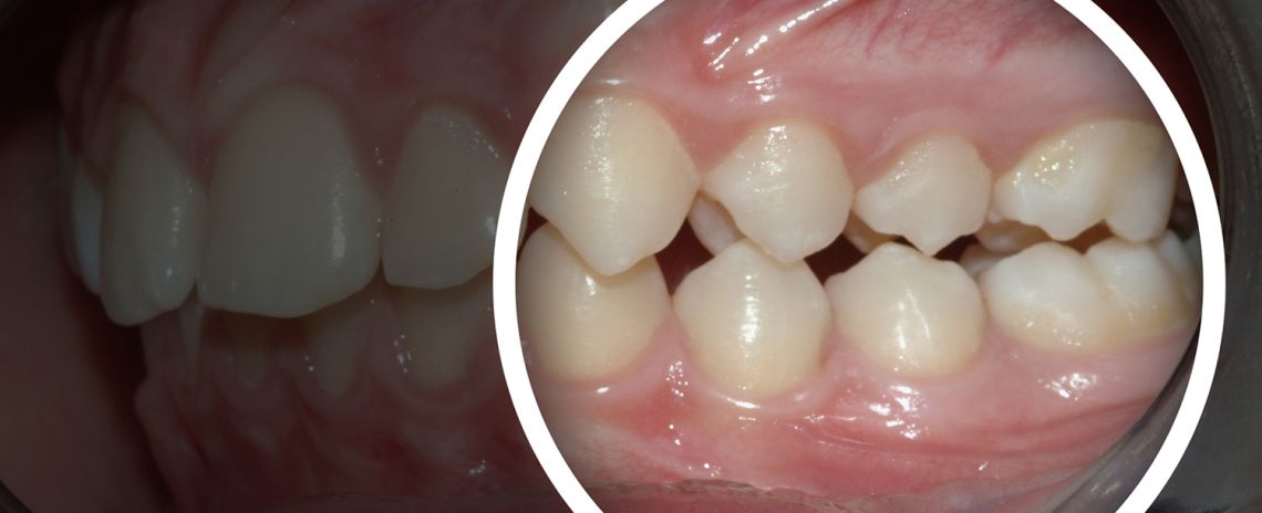 Bite Concerns Teeth Straightening Before