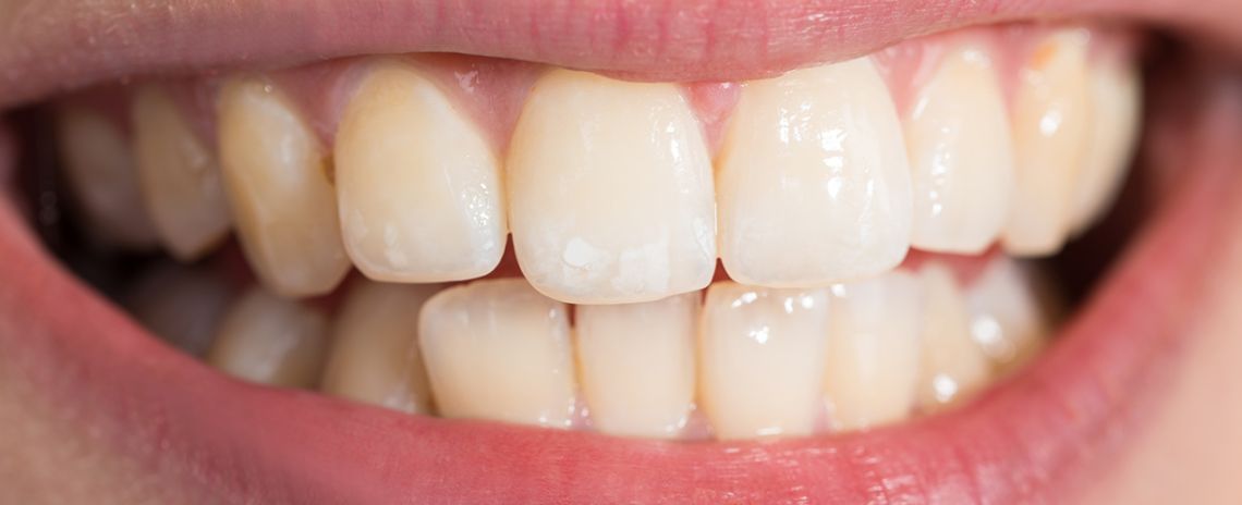  Teeth Whitening Before