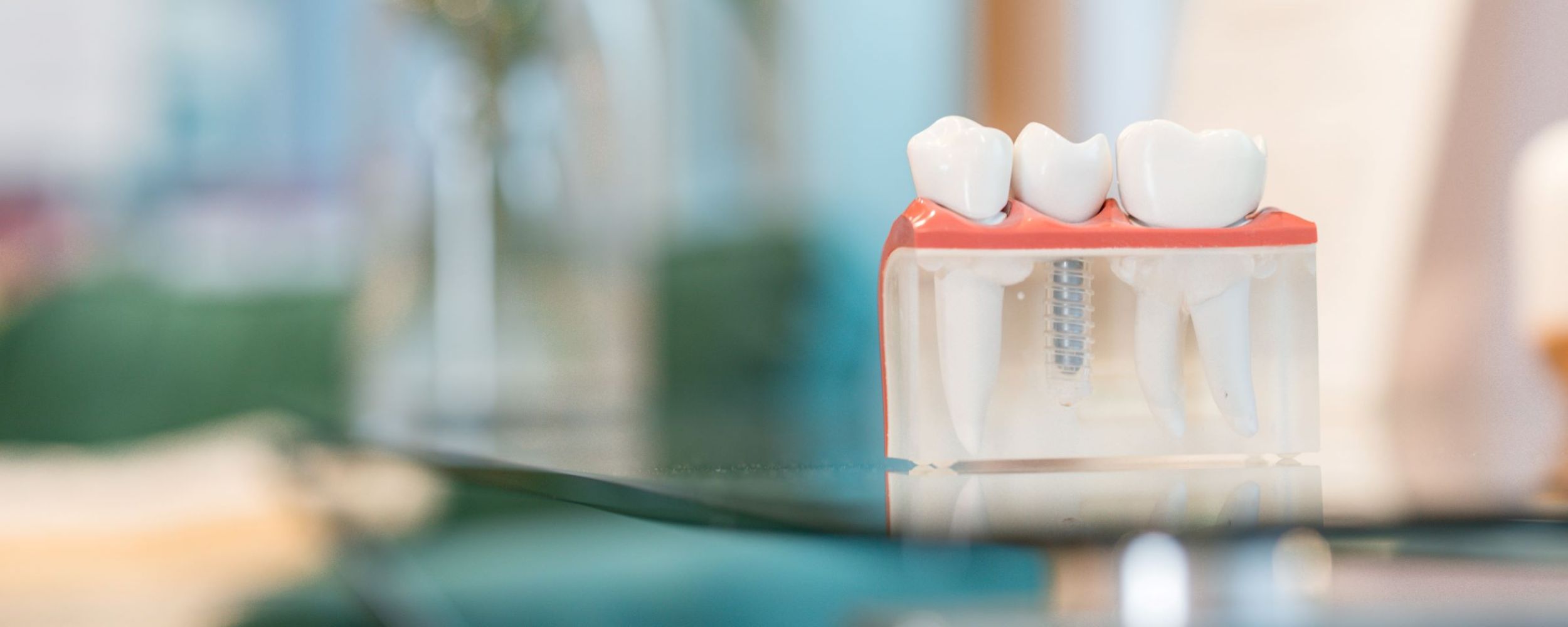 Implant secured dentures