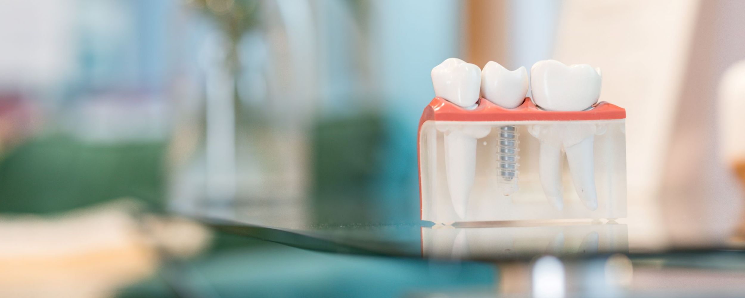 Single tooth dental implants