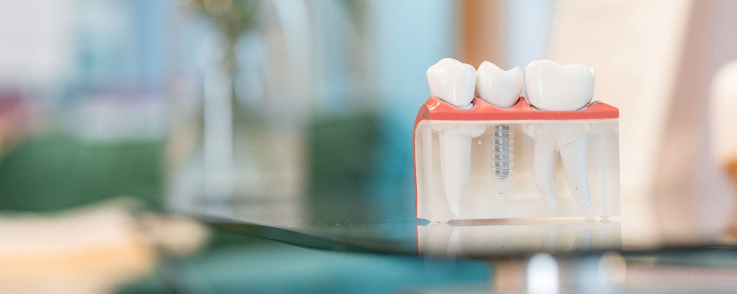 Multiple teeth dental implants